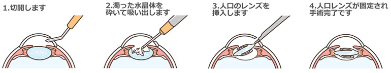 あしざわ眼科クリニックの日帰り白内障手術